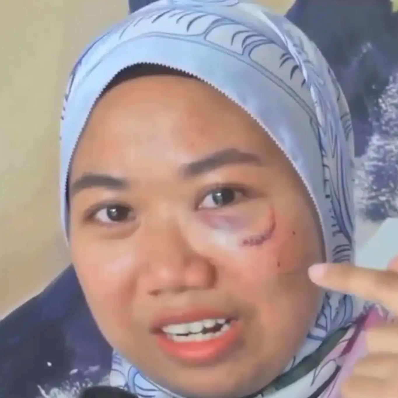 shuhada terima ‘hadiah’ hari jadi lebih 10 jahitan akibat ditumbuk hafidz roshdi