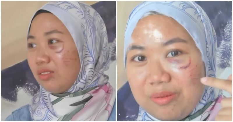 shuhada terima ‘hadiah’ hari jadi lebih 10 jahitan akibat ditumbuk hafidz roshdi