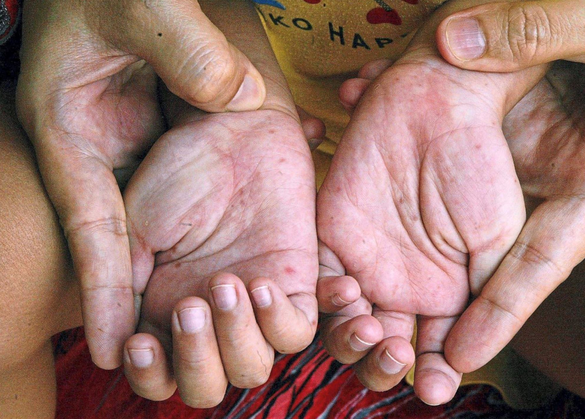 surge in weekly hfmd cases exceeds national alert level, warns health dg