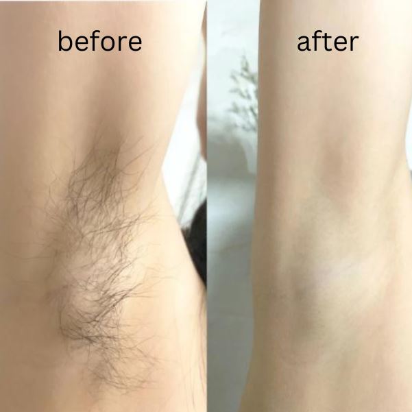 before after ULike IPL device