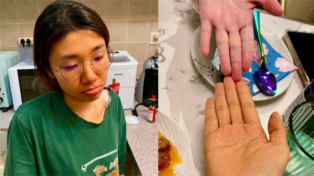 连吃胡萝卜3个月减肥!女子遭胡萝卜染色!