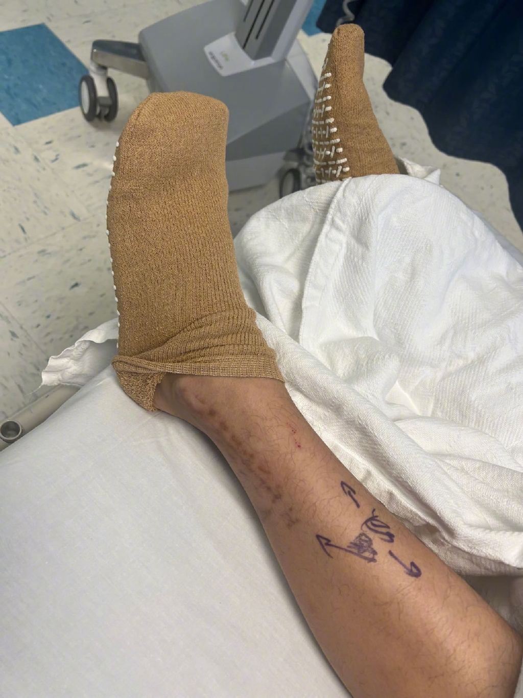 陈学冬晒图自曝车祸后第三次手术结束❗被医生告知一定会风湿😱