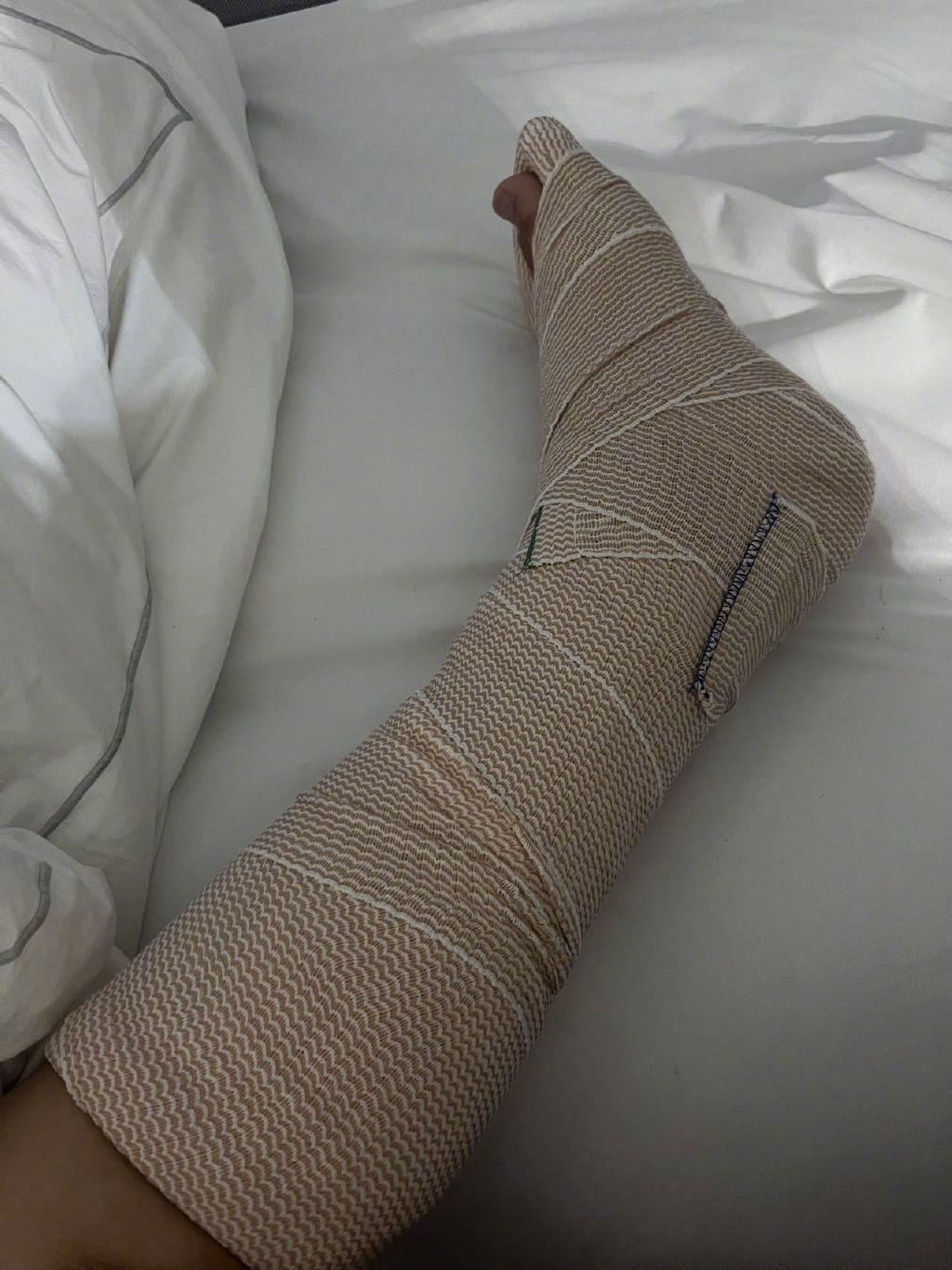 陈学冬晒图自曝车祸后第三次手术结束❗被医生告知一定会风湿😱