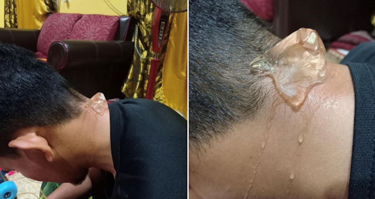 letas ais belakang leher boleh rawat migrain? “macam tak percaya betul jadi..”