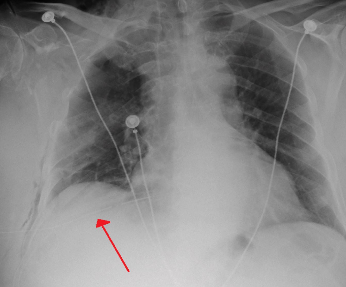 paru-paru lelaki ini runtuh lepas jerit kuat sangat di konsert 