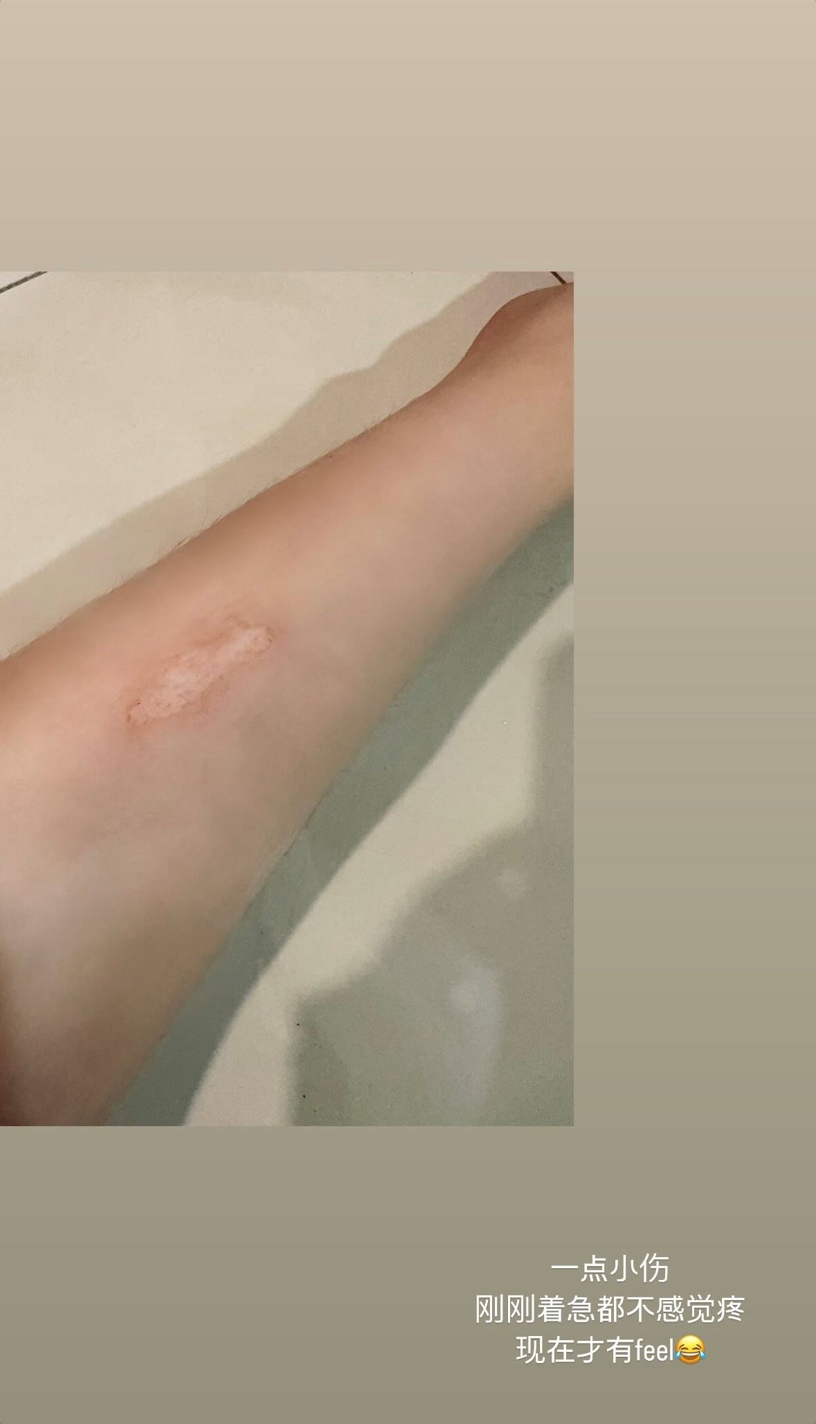 geraldine颜慧萍充电宝爆炸💥小腿被烫伤😱