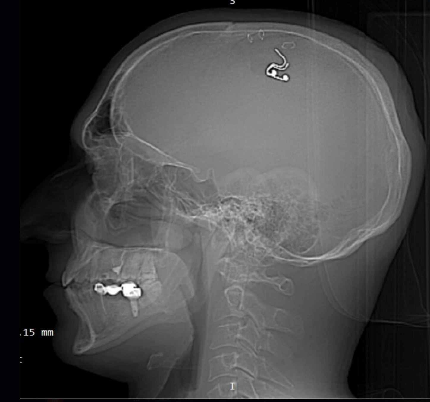 lelaki sanggup tebuk tengkorak, tanam cip dalam otak sebab nak kawal mimpi