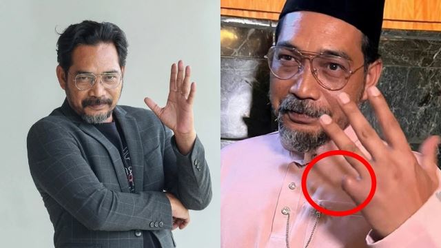 shahronizam akui trauma hilang jari kelingking