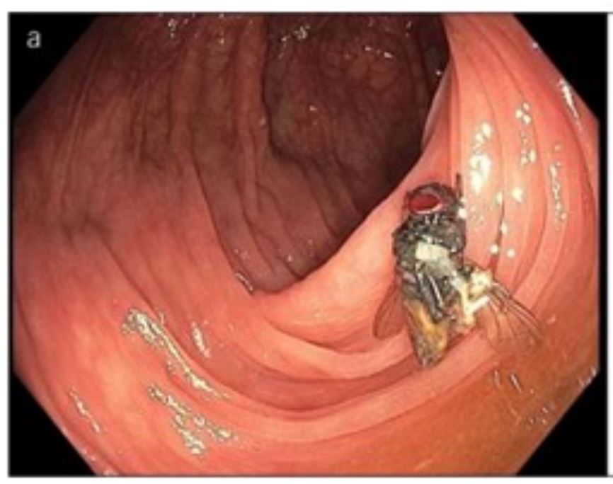 doktor terkejut jumpa lalat hidup dalam usus pesakit umur 63 tahun