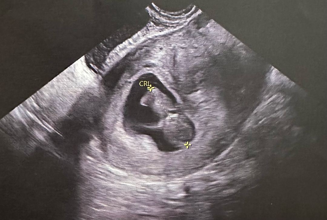 杨潮凯宣布妻子怀二胎❗catharinebb做家姐啦🔥