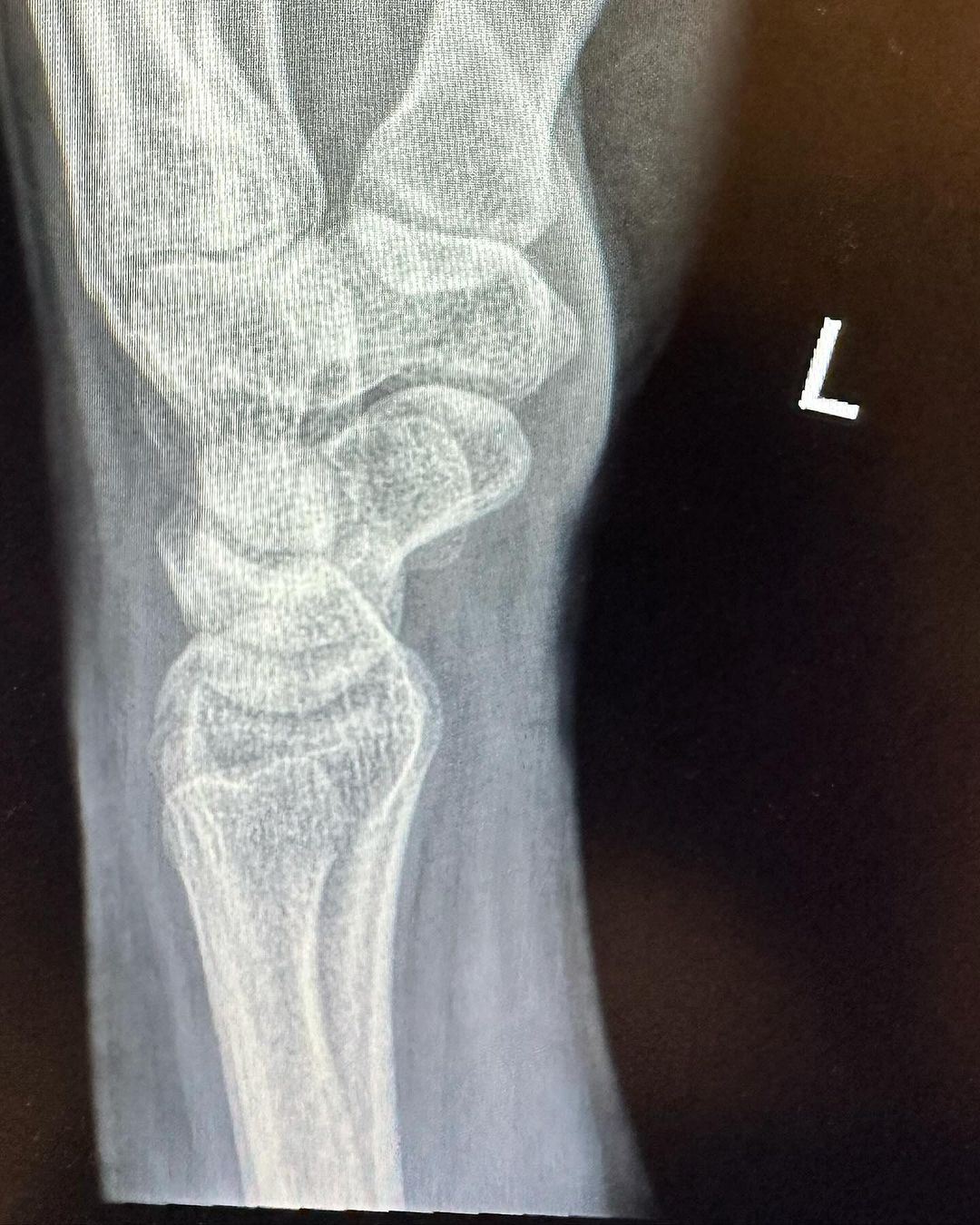 tulang lengan tangan azira shafinaz retak, minta doa agar cepat sembuh