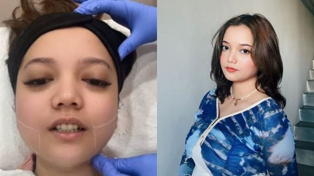 netizen sangka leona hidap tiroid, pilih buang lemak di dagu