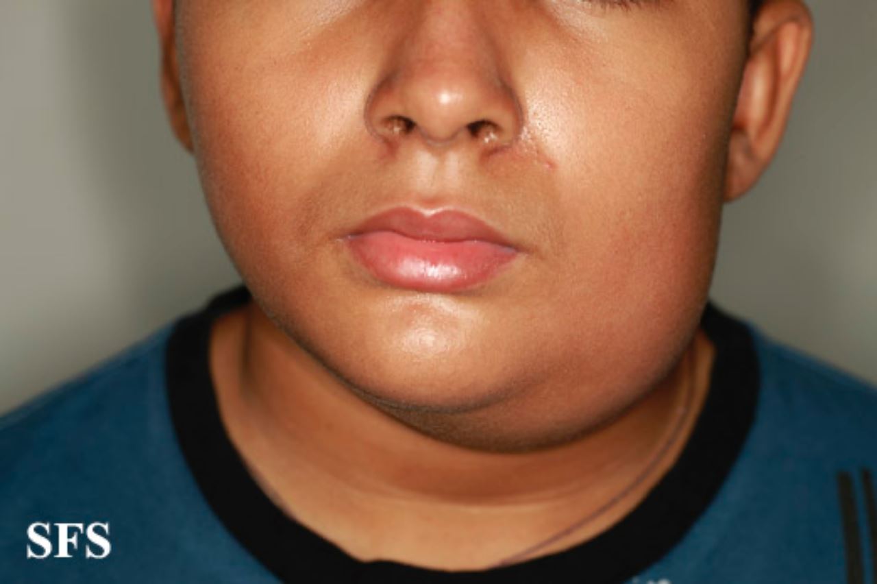 virus beguk mudah jangkit pada kanak-kanak, “boleh cegah dengan vaksinasi” – kkm