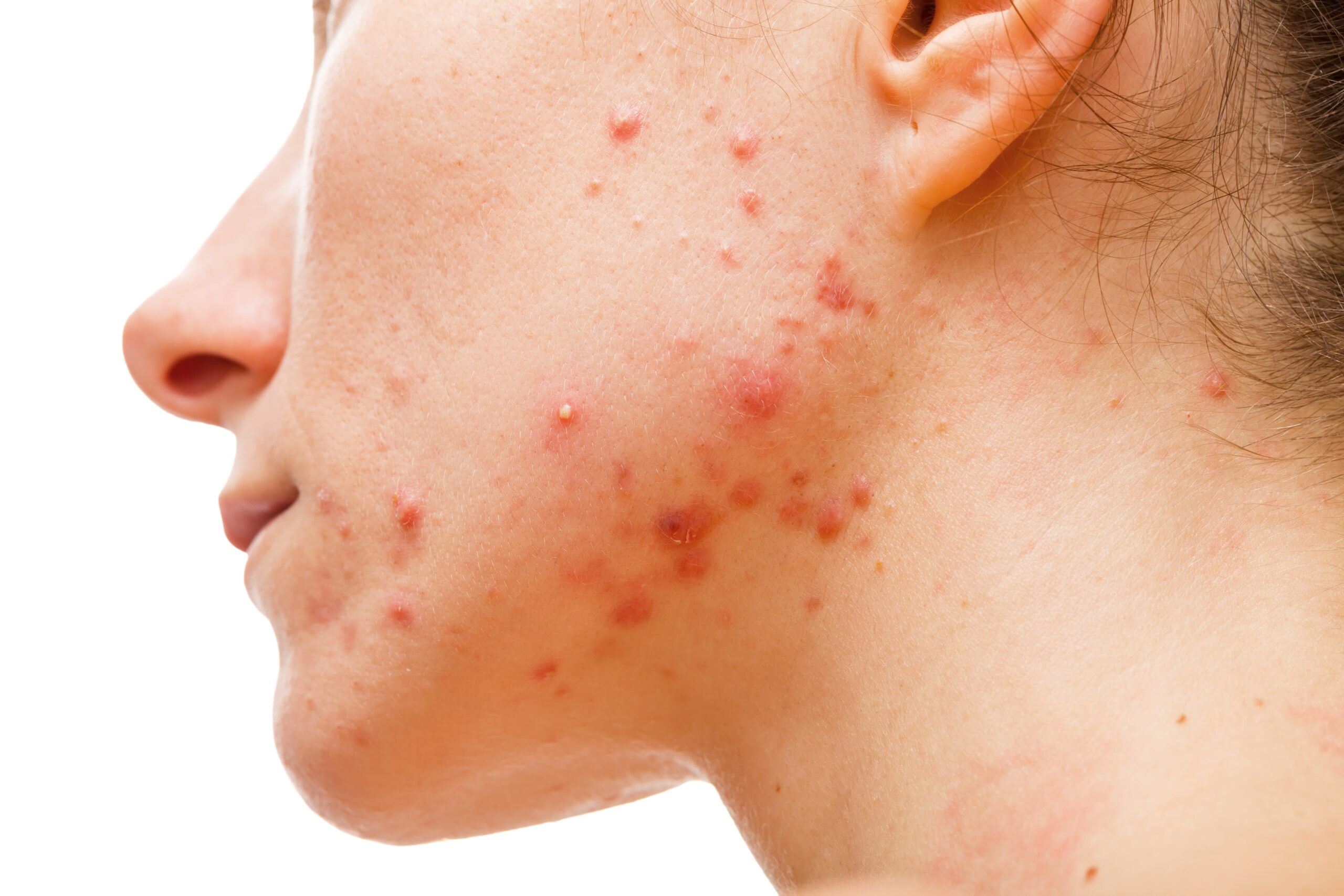 why hormonal acne may persist into adulthood and how to manage it
