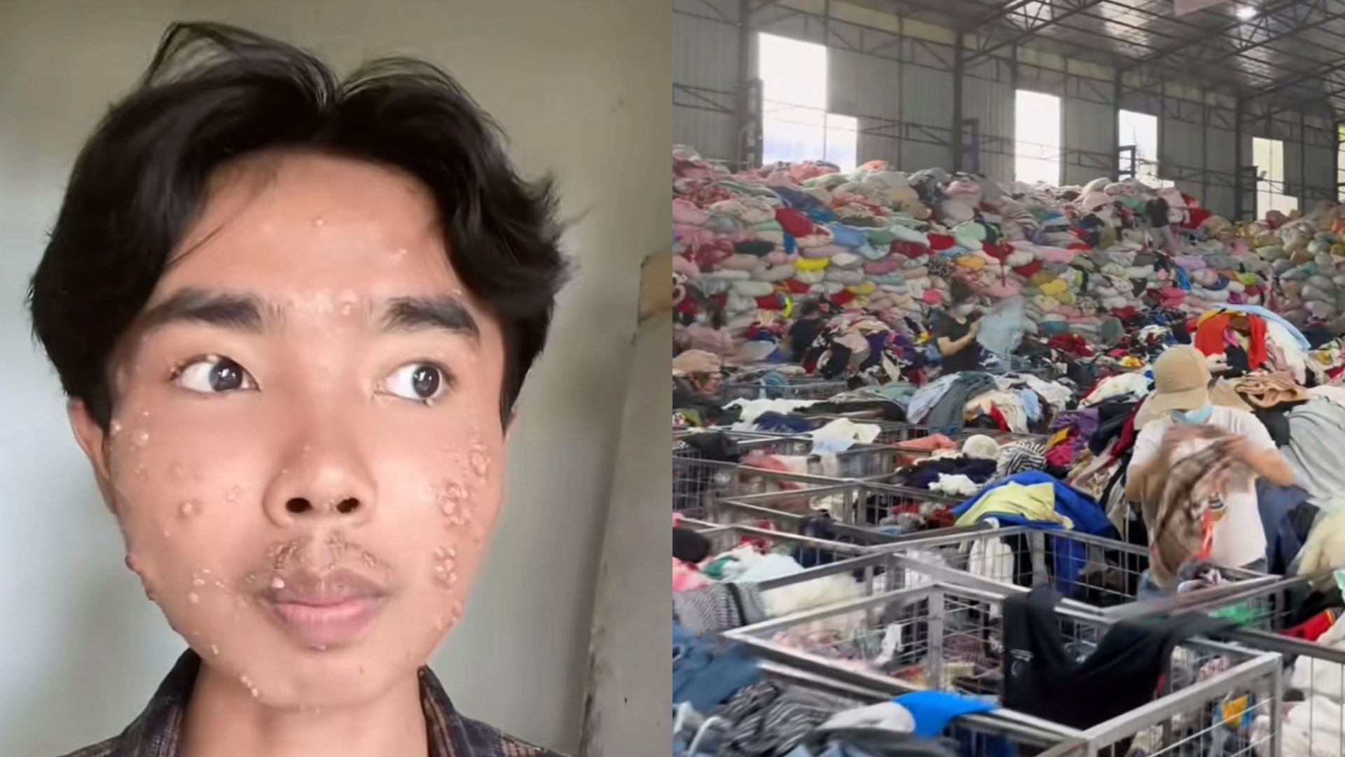 “tangan naik ruam, muka gatal” – lelaki kongsi padah pakai baju bundle tak cuci dengan betul