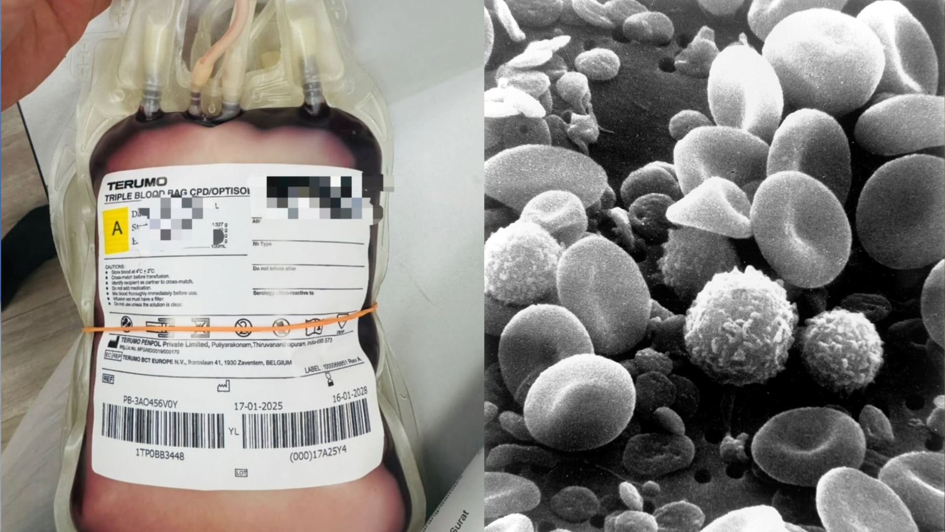 darah kelihatan putih dan pekat? tanda kolesterol tinggi, bukan anda keturunan mahsuri