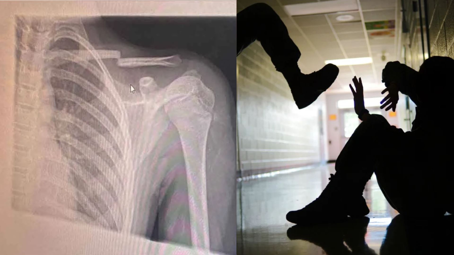 murid cedera patah tulang selangka akibat buli di sekolah