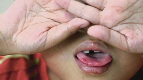 hampir 40,000 kes wabak hfmd di selangor, kluster banyak di rumah & taska 