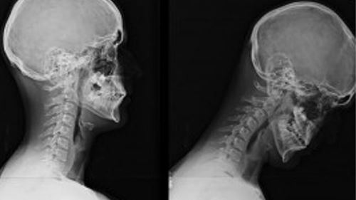 setiap kali tunduk lihat telefon leher anda menanggung 12kg beban, awas sindrom text neck!