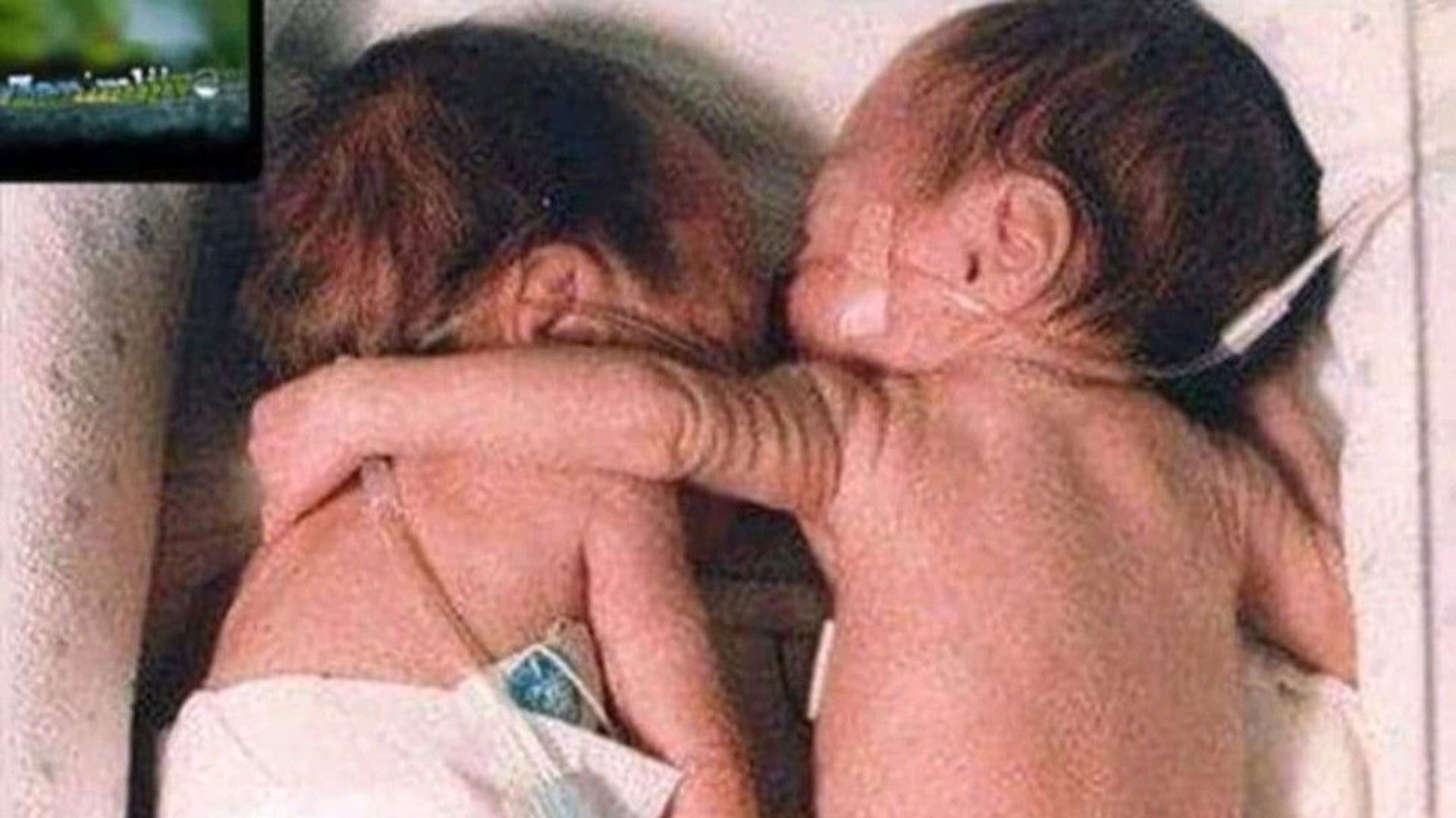 pelukan yang menyelamatkan, kisah bayi kembar pramatang yang mengubah dunia perubatan