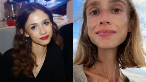 obsesi diet ekstrem ragut nyawa, wanita meninggal dunia akibat kekurangan zat