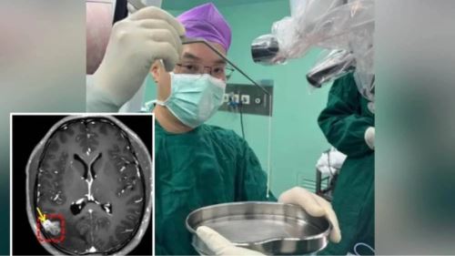 akibat telan hempedu ular mentah, cacing pita babi bersarang dalam otak!