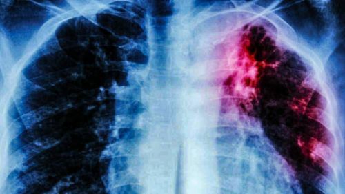 33 positif tibi di kota tinggi, kkm perhebat operasi bendung penularan